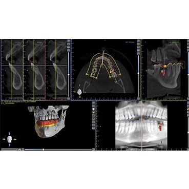 Planning of Implant Surgical Guide